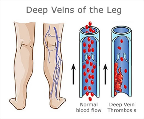 deep vein thrombosis
