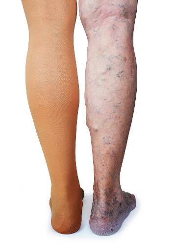 image of deep vein thrombosis and varicose veins needing compression stockings