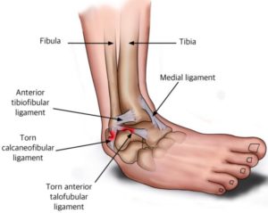 labelled image showing ankle sprains