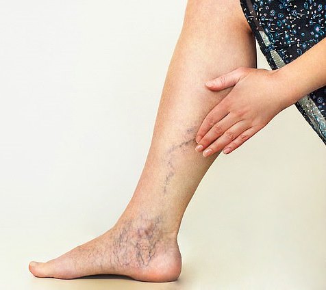 changes on leg and toe due to varicose veins infection