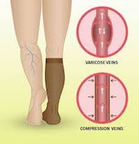 Blood flow shown with vein constriction with or without compression socks. Without constriction the vein is more round, with constriction the veins are straighter and more effective.