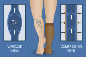 15 – 20 mmHg, 20 – 30 mmHg, or 30 – 40 mmHg knee high or thigh high compression socks improve venous competence