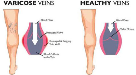 competent versus incompetent venous valve