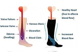 Illustration of leg and feet with swelling, blood clots and other conditions and side by side with an illustration of leg and feet wearing compression sock shows it increases blood flow. 