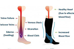 Are You a Nurse? Find Out the Right Compression Socks for Nurses Here