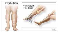 lymph-edeme-example-needs-compression-stockings