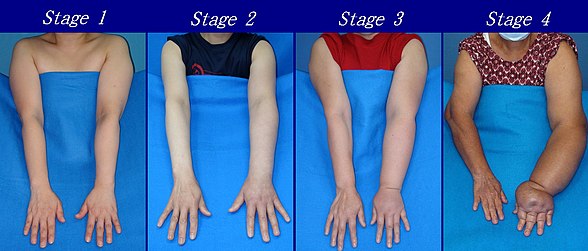 Different stages of lymphedema