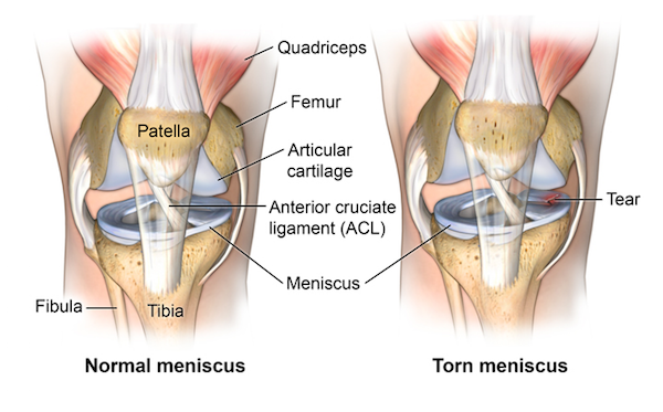 Normal vs torn meniscus