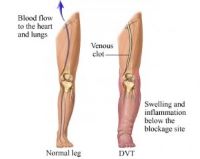 Normal vs DVT