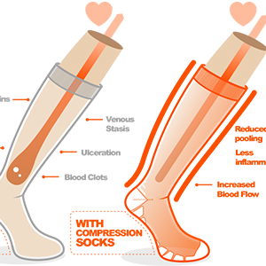 Zippered Compression Stockings 15-20 mmHG - (So Quick and Easy!)