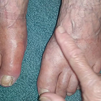pedal edema