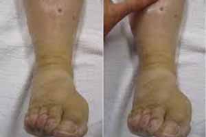 peripheral edema
