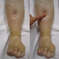 peripheral edema of the lower limb