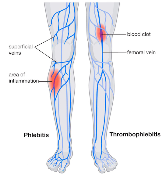 Graphic of Phlebitis and Thrombophlebitis