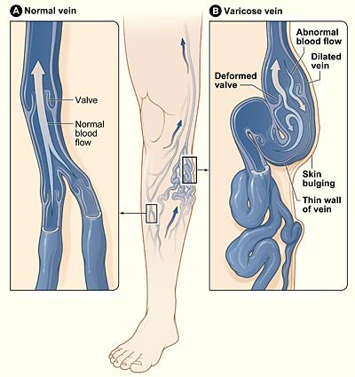 helpful chart on compression stocking,spider vein and varicose vein