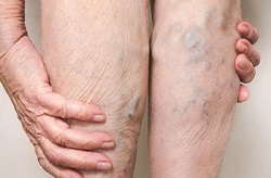 men suffering from pooling of blood in leg due to sitting for longer periods and not wearing knee high compression socks