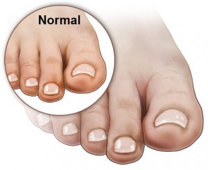 an image contrasting poor and normal blood circulation in the foot