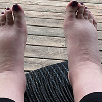 pregnancy induced edema