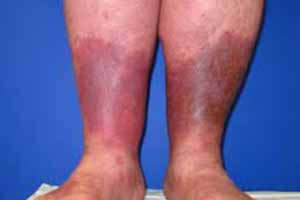 prevent lipodermatosclerosis