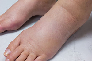  An image showing feet with edema