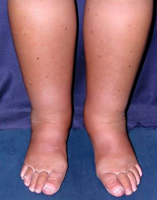 prevent pedal edema