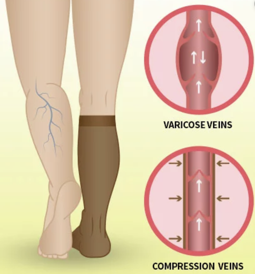 Wide Calf Compression Socks The Quest for the Perfect Size Sock