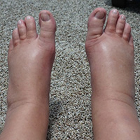 prevention of edema or swelling legs