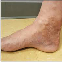reduce the recurrent of superficial vein thrombosis with 15 to 20 mmHg, 20 to 30 mmHg, or 30 to 40 mmHg knee high graduated clothing