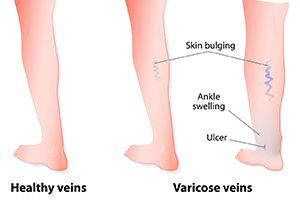 skin bulging and ankle swelling