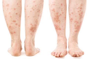 Example of skin disease on legs