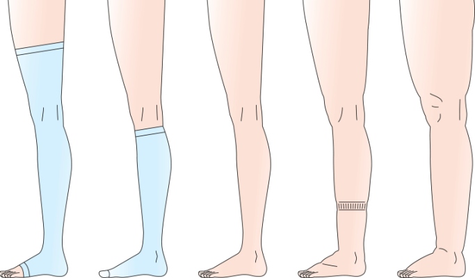 compression stockings for edema