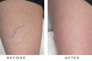 spider veins - before and after wearing support hosiery