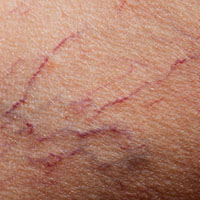 spider veins that can be treated with medical hoses