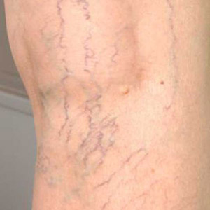 spider veins