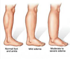 stages of edema