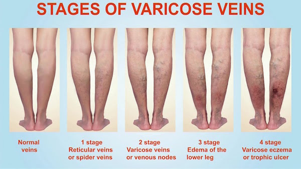 Stages of varicose veins