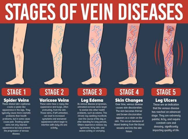 degenerative stages of vein thrombosis