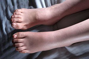 compression can alleviate swollen feet