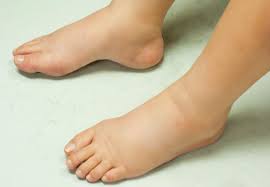  A picture of a feet pregnancy condition (edema)