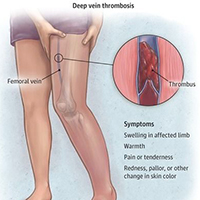 deep-vein-thrombosis-symptoms that can be treated with 15 - 20 mmHg, 20 - 30 mmHg, or 30 - 40 mmHg knee or thigh high