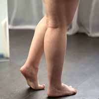 treat swelling legs with medical hosiery