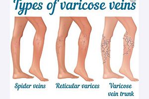 types of varicose veins