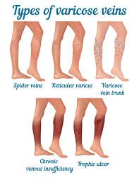 types of varicose veins