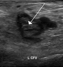 Deep vein thrombosis ultrasound showing blood clot in the middle of a vein. This is a serious condition that compression clothing can help prevent.