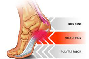 understanding plantar-fasciitis in detail