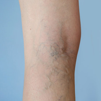 a person's leg showing varicose veins 