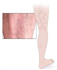 image showing varicose vein