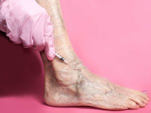 image of leg with varicose veins