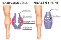 A picture of healthy knee and varicose vein