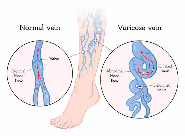 Graphic explaining varicose veins